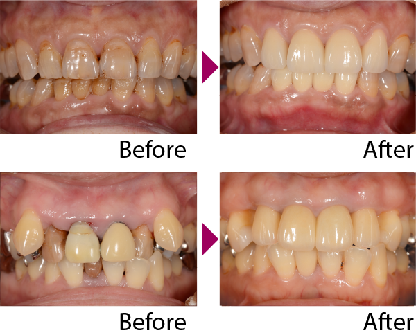 セラミック治療Before-After